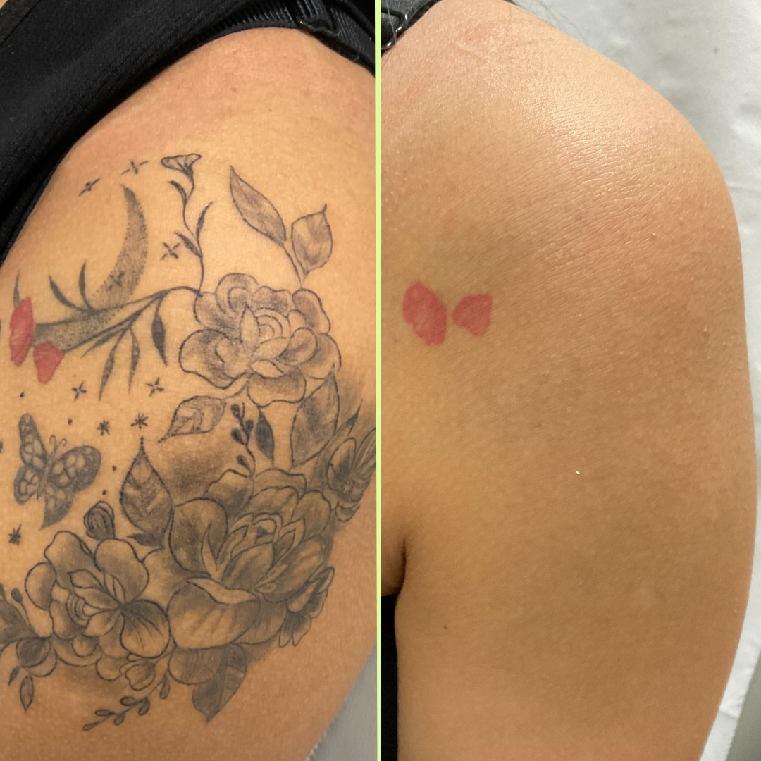Arm tattoo removal 