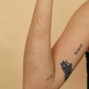 Laser tattoo removal has faded ost of the tattoo