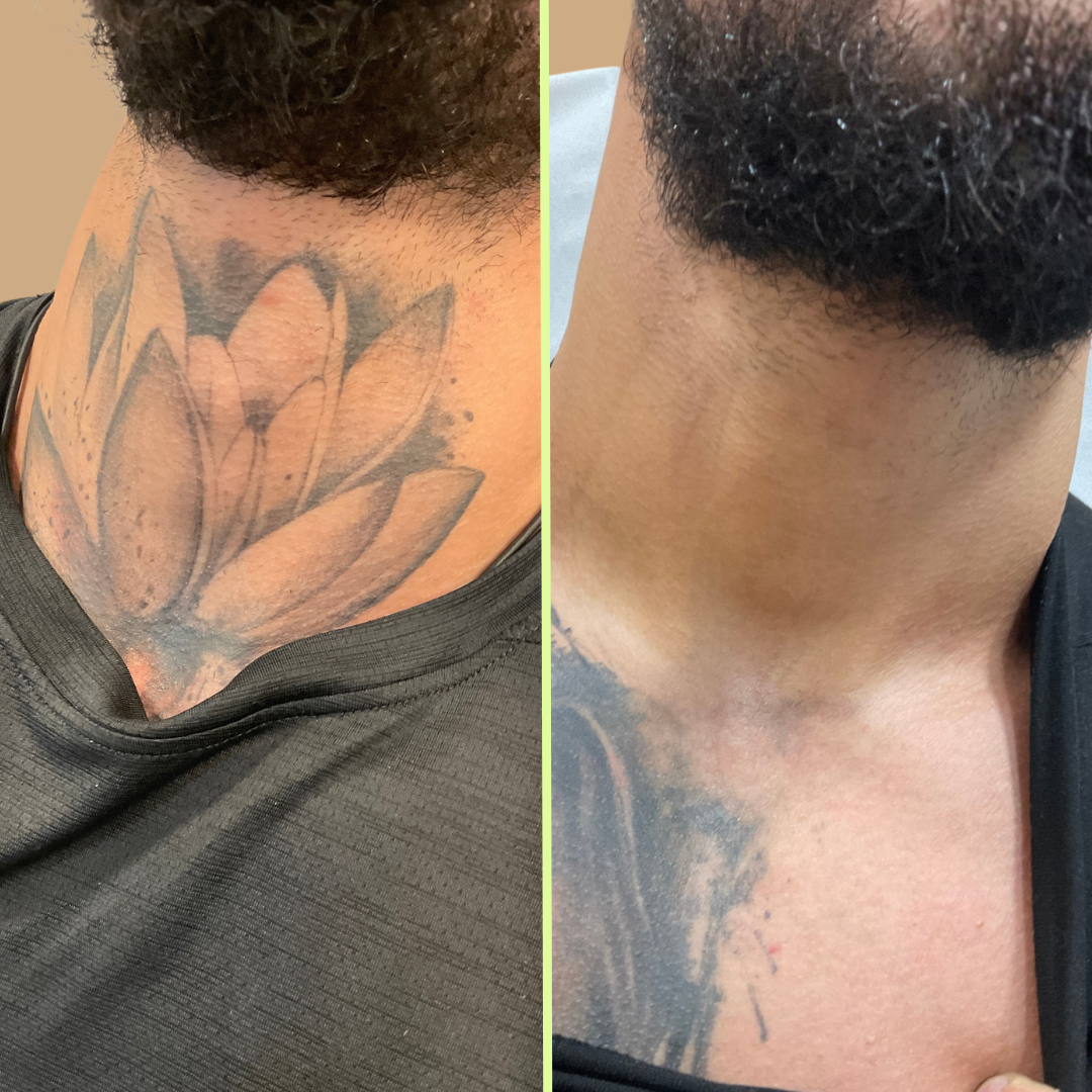 Neck tattoo removal 
