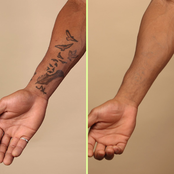 Arm tattoo removal