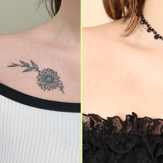 DIY Home Tattoo Removal with Tria Laser  Cris and that