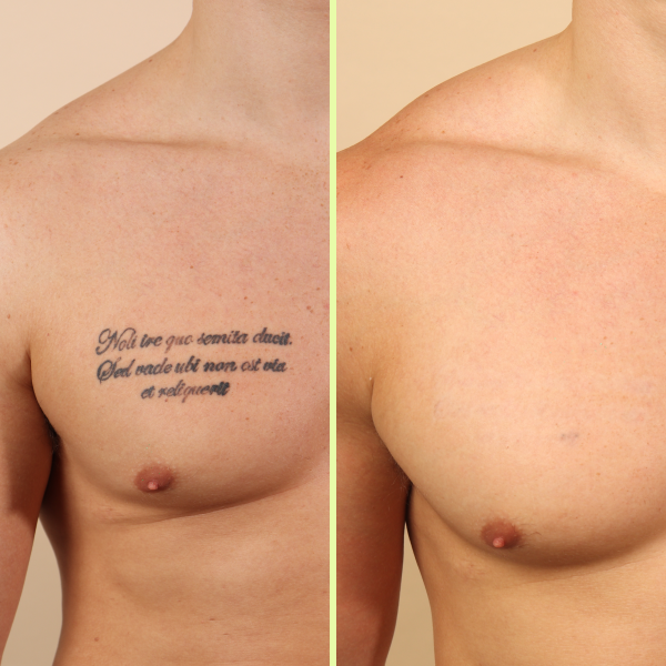 Chest tattoo removal