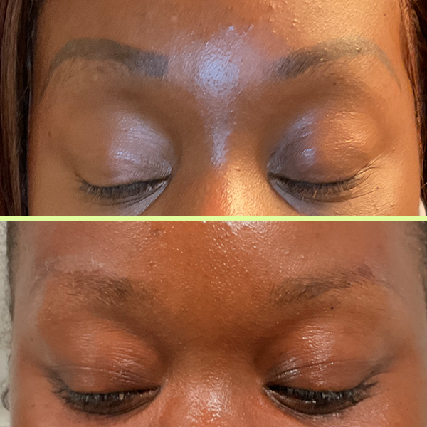 Eyebrow tattoo removal process - before and after