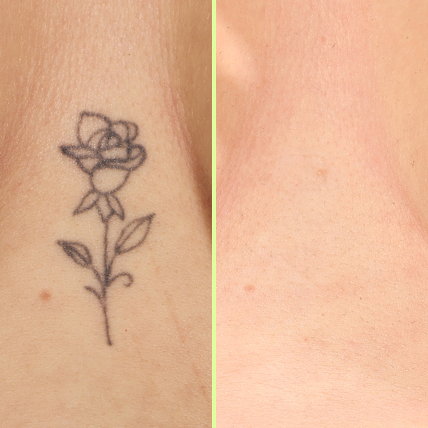 Sternum tattoo removal