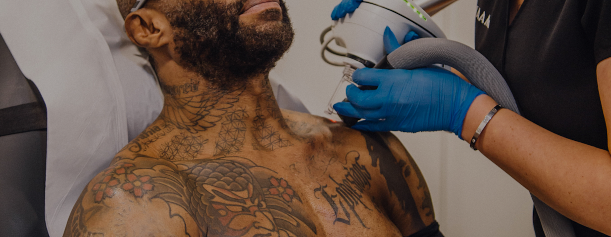 Tattoo fading for a cover-up