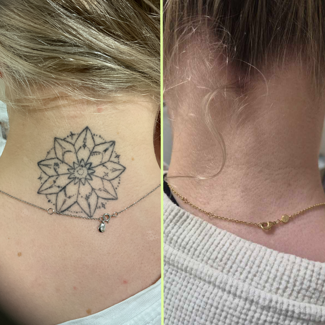 Back of neck tattoo removal