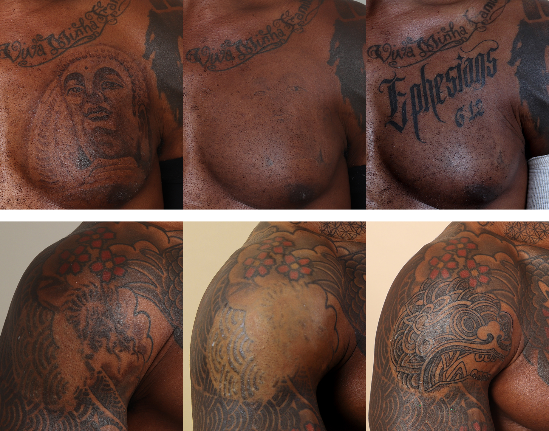 Transformations Plastic Surgery | Laser Tattoo Removal From Transformations  Plastic Surgery | Rockford, IL | Seize the Deal