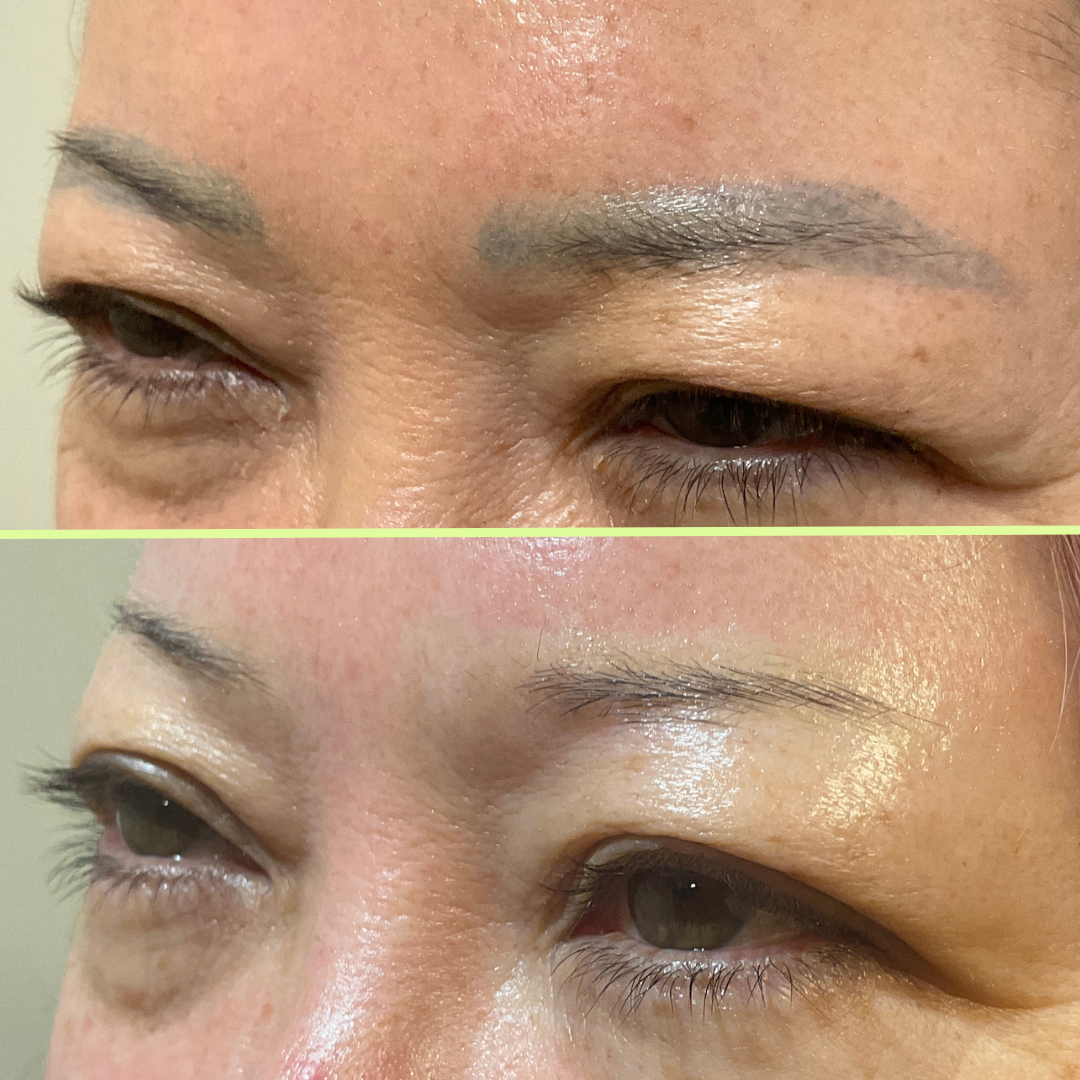 Eyebrow tattoo removal