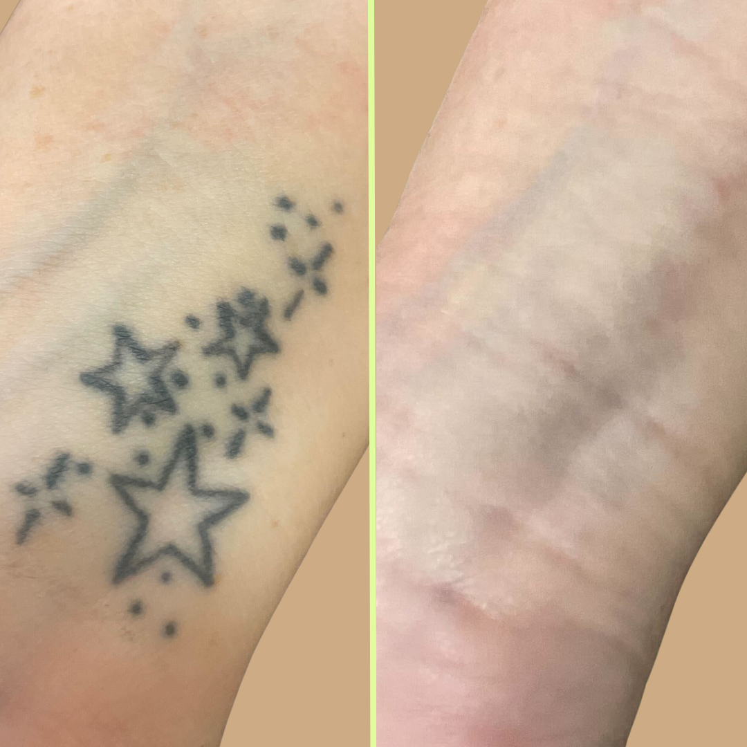 Wrist tattoo removal