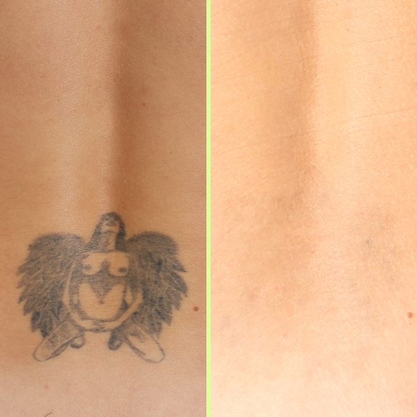 Lower back tattoo removal