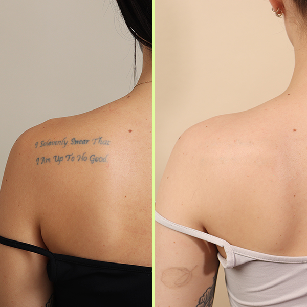 Shoulder tattoo removal