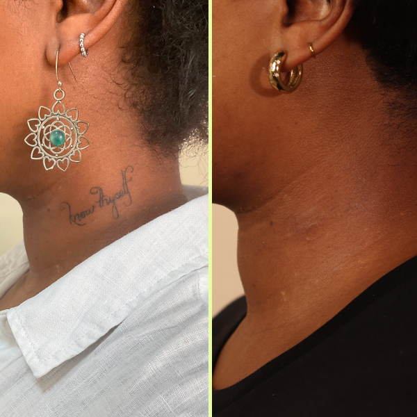 SIde of neck tattoo removal