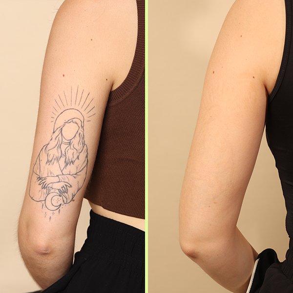 Arm tattoo removal