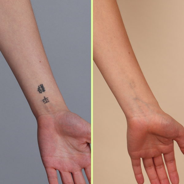 Wrist tattoo removal