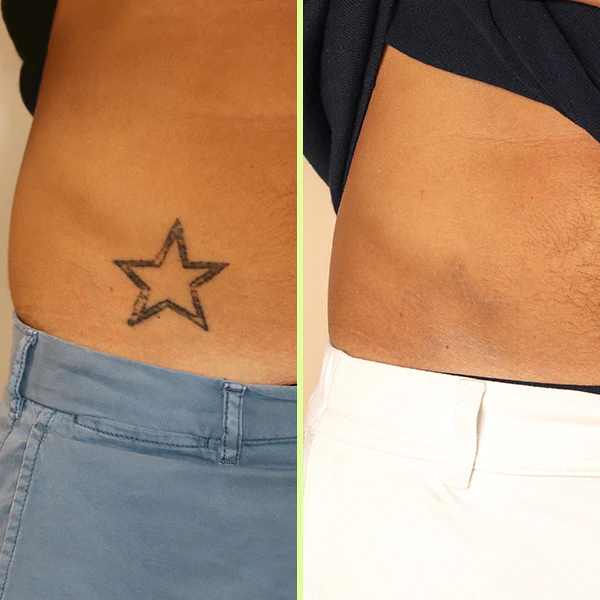 Tattoo Removal in South Delhi - Best and Permanent Solution