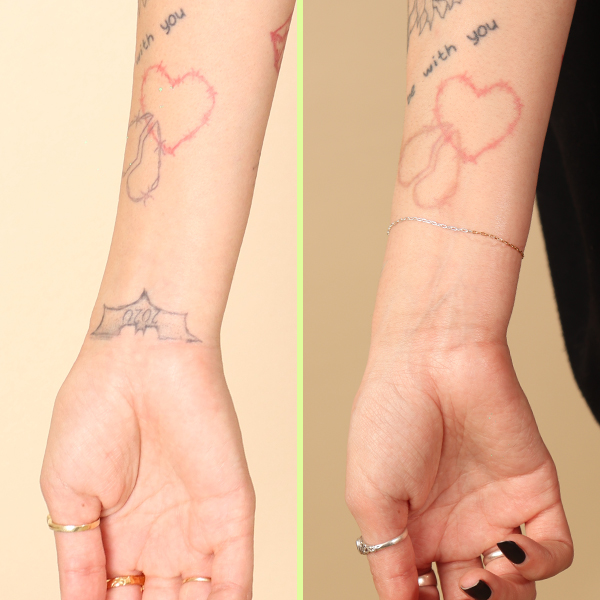 Wrist tattoo removal