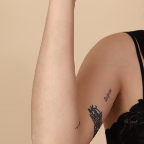 After 6 laser treatments Bella has clear skin