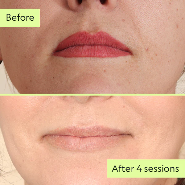 Before & after lip blushing removal images.