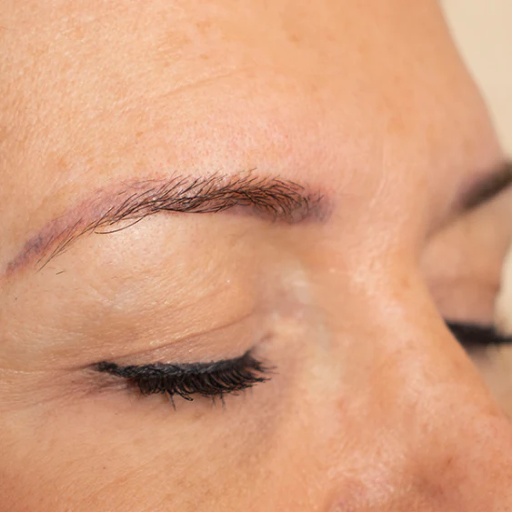 Image showing microblading removal treatment results