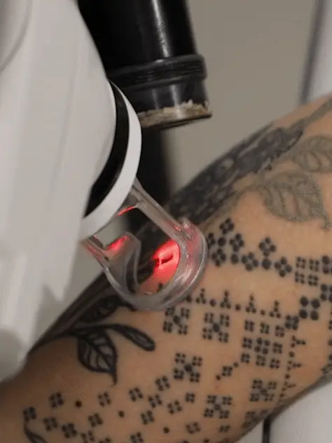NAAMA's laser tattoo removal treatment.