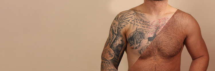 The results are in. Tattoo removal before and afters