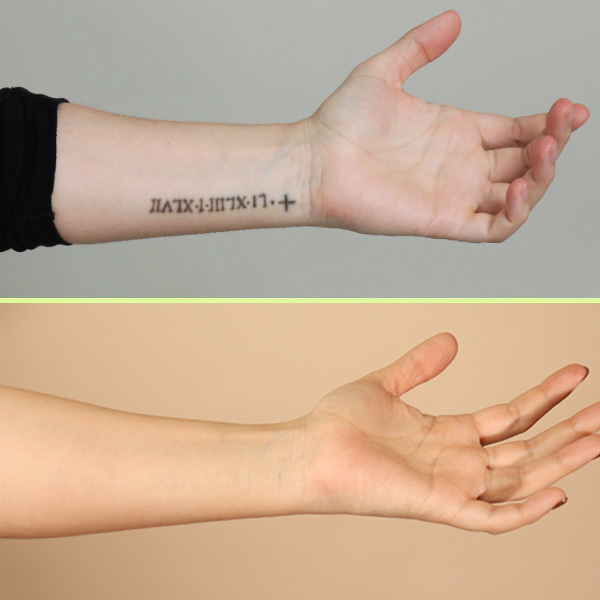 Forearm tattoo removal