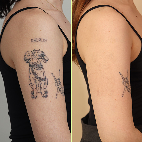 Multiple tattoo removal
