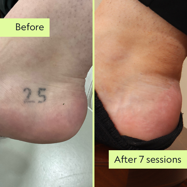 Image: A client's stick-and-poke tattoo before and after treatment.