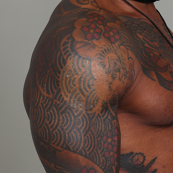 Removal for a cover-up: “It’s gone. I’m still amazed. The tattooist that I went to was amazed.”