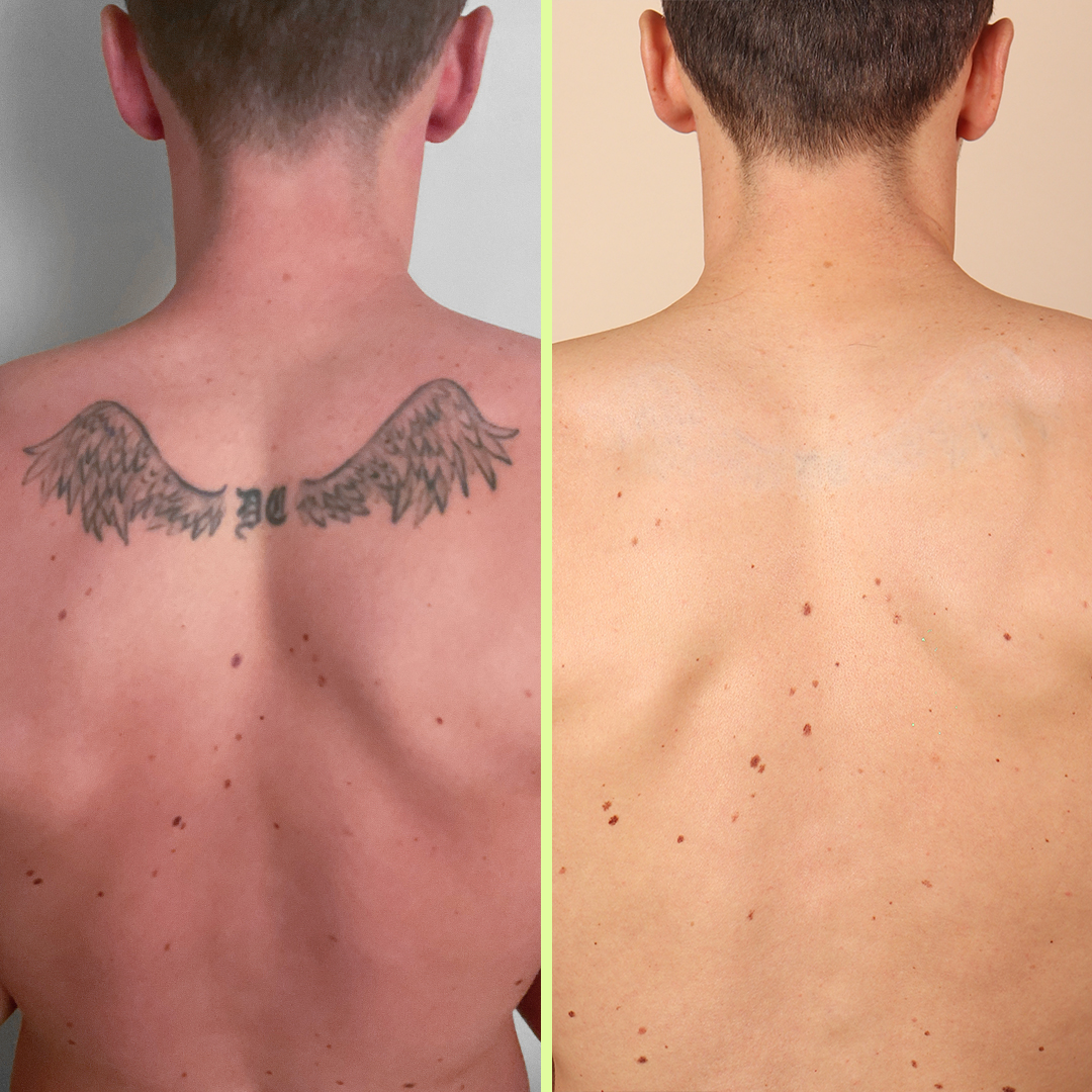 Laser tattoo removal before and after. Attractive Man with tattoo on his  chest Stock Photo | Adobe Stock