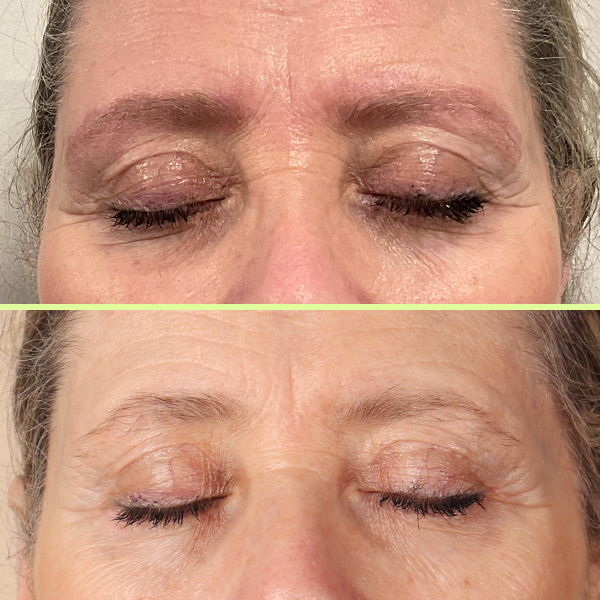 Eyebrow tattoo removal