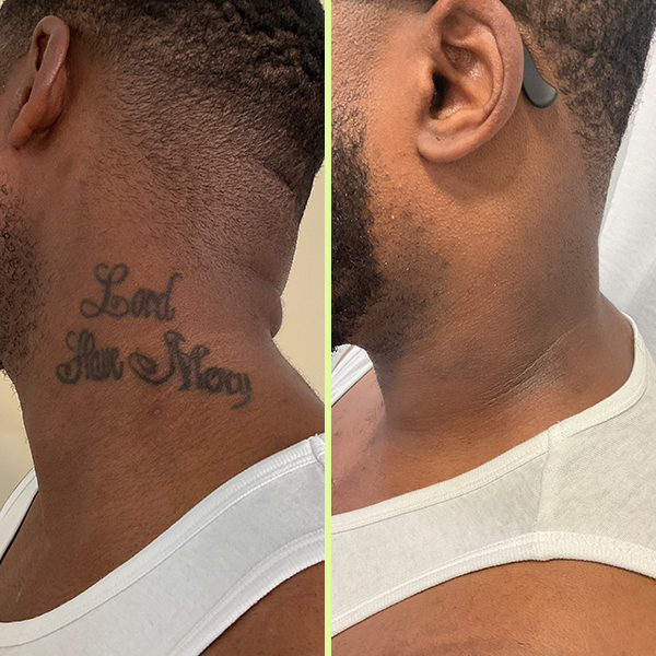 How Does Laser Tattoo Removal Work?: Pain, Effectiveness, Safety