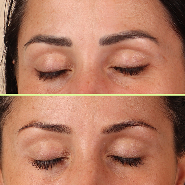 Eyebrow tattoo removal