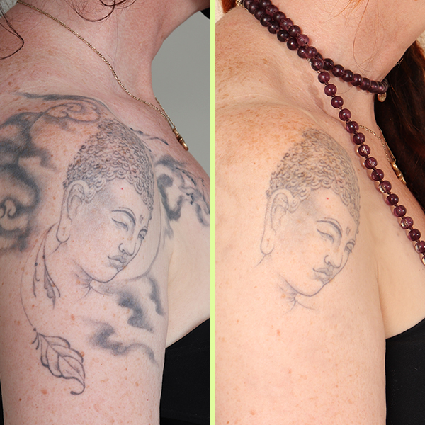 Arm partial tattoo removal