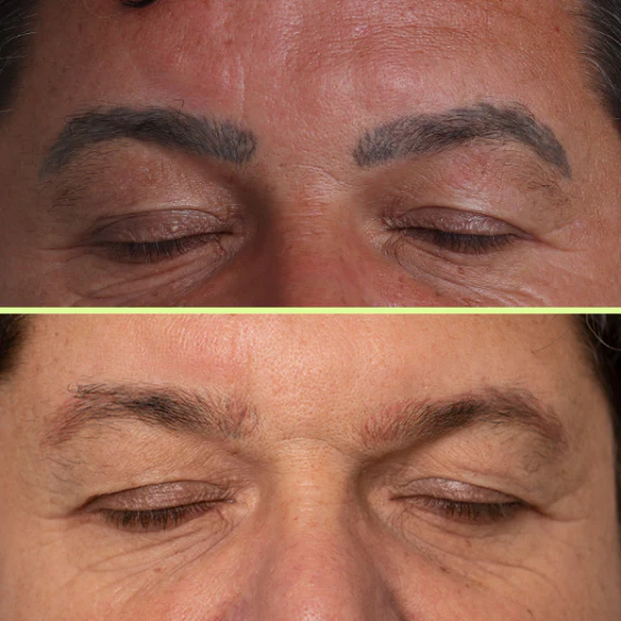 Eyebrow tattoo removed after 5 sessions