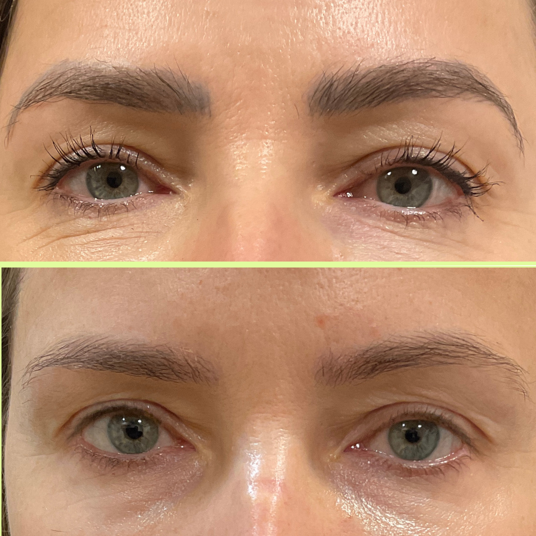 Eyebrow tattoo removal