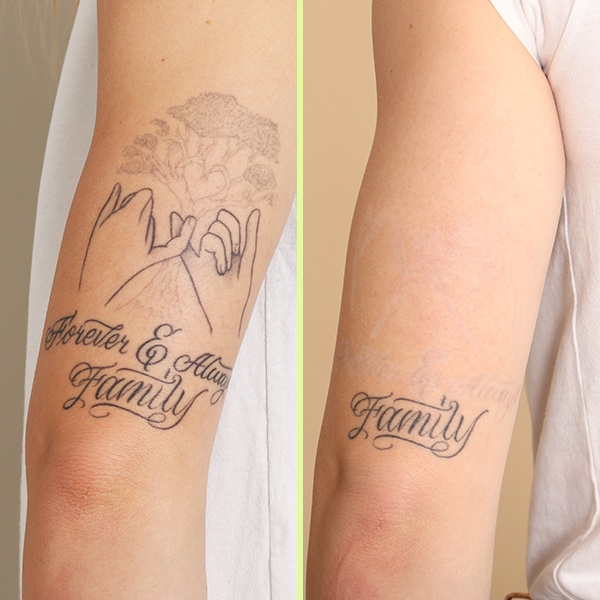 Back of arm tattoo removal