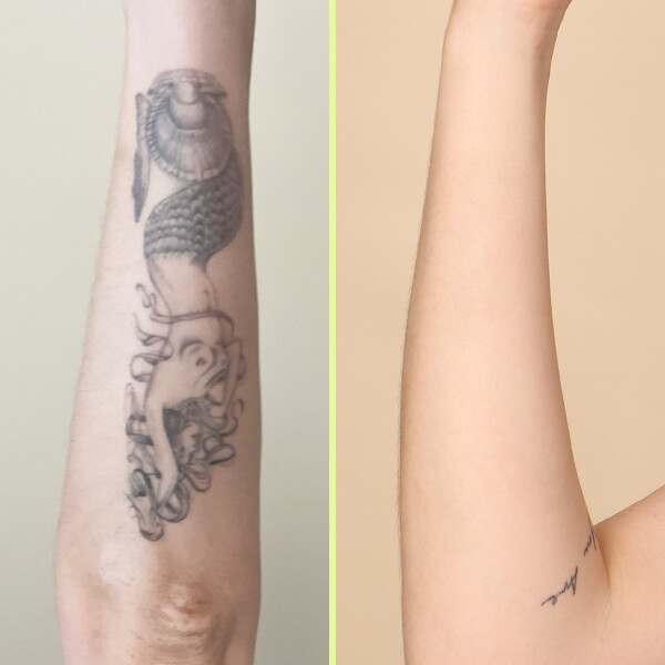 Tattoo removal London - before and after results.