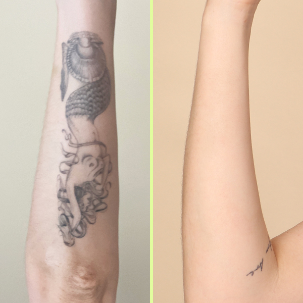 Reducing the Cost of Tattoo Removal: How to Maximize Your Laser Tattoo  Removal Treatments' Results - Reflections Center