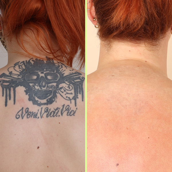 Back tattoo removal