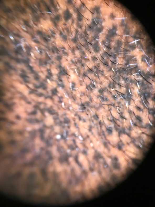 April Scalp PMU