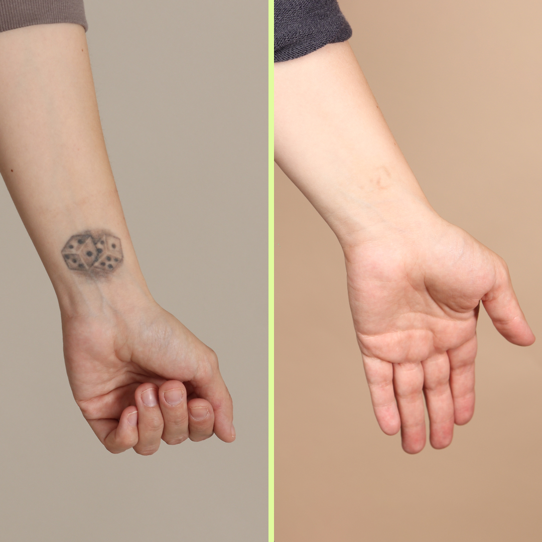 Wrist tattoo removal