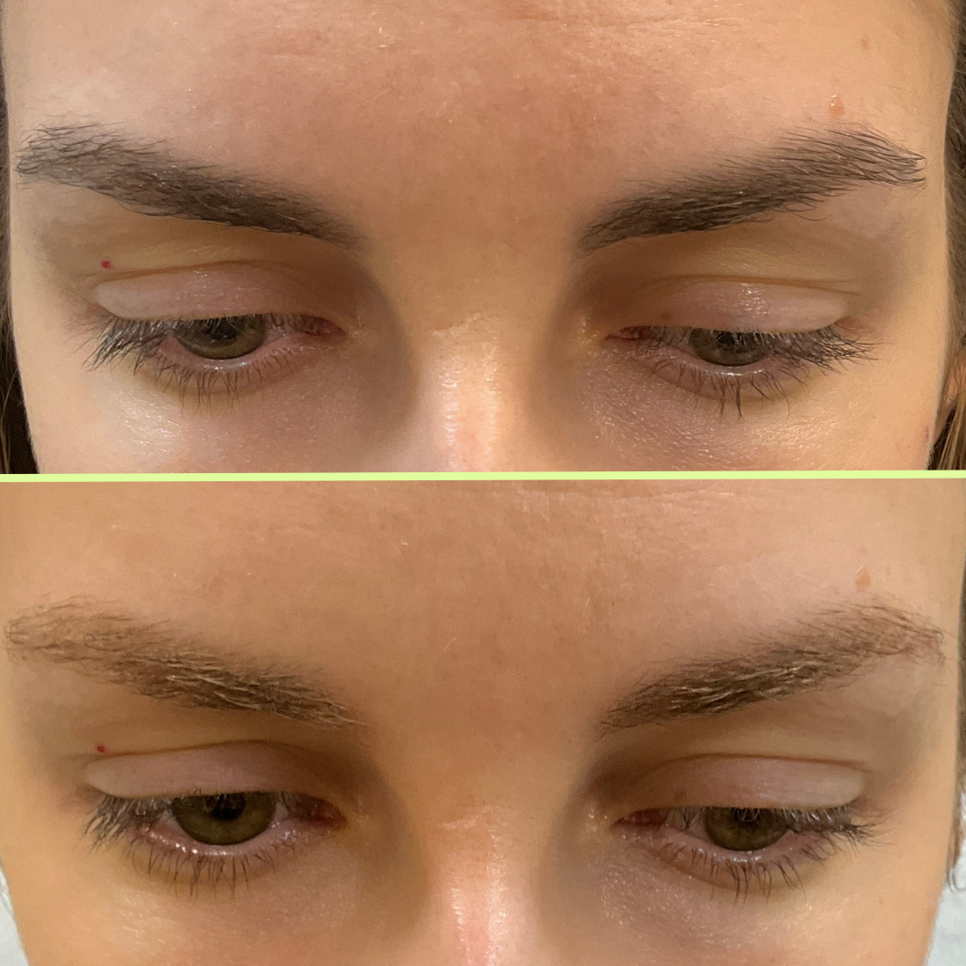 Eyebrow tattoo removal