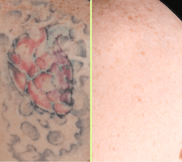 Before and after laser tattoo removal in our London studio.