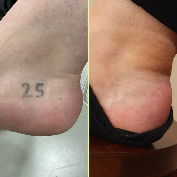 Ankle tattoo removal