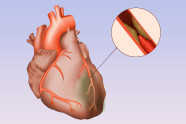 ISCHEMIA Trial Is Revascularization Worth The Risk 