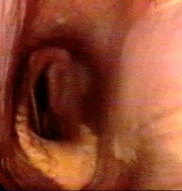 A dynamic endoscope image of the collapsed left arytenoid of a horse that roars.