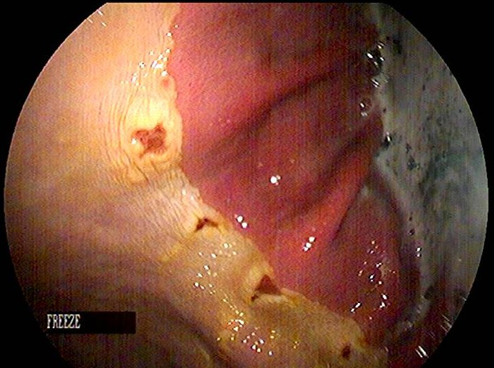 Grade 2 squamous ulceration identified through gastroscopy.