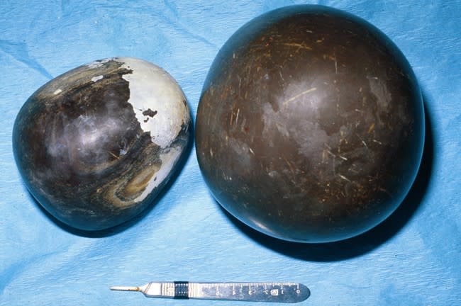 Two enteroliths, stones that form within a horse's digestive system, on a surgical table.