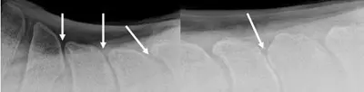 An x-ray of a horse with kissing spines shows the impinged areas of narrowed spacing and bone remodeling of the spinous processes. 
